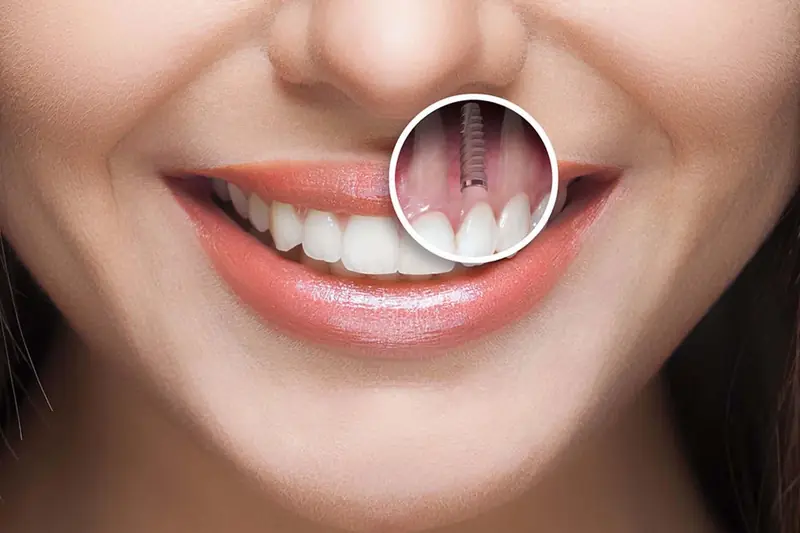 Implante dentário em Porto Alegre